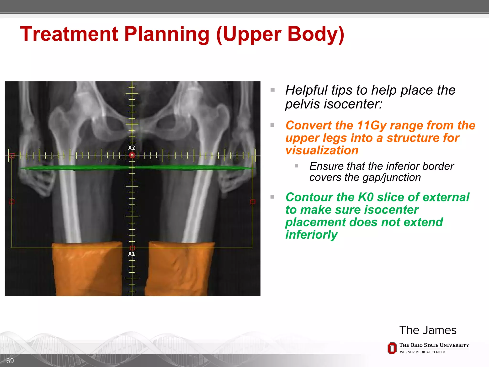  Helpful tips to help place the
pelvis isocenter:
 Convert the 11Gy range from the
upper legs into a structure for
visualization
 Ensure that the inferior border
covers the gap/junction
 Contour the K0 slice of external
to make sure isocenter
placement does not extend
inferiorly
69
Treatment Planning (Upper Body)
 