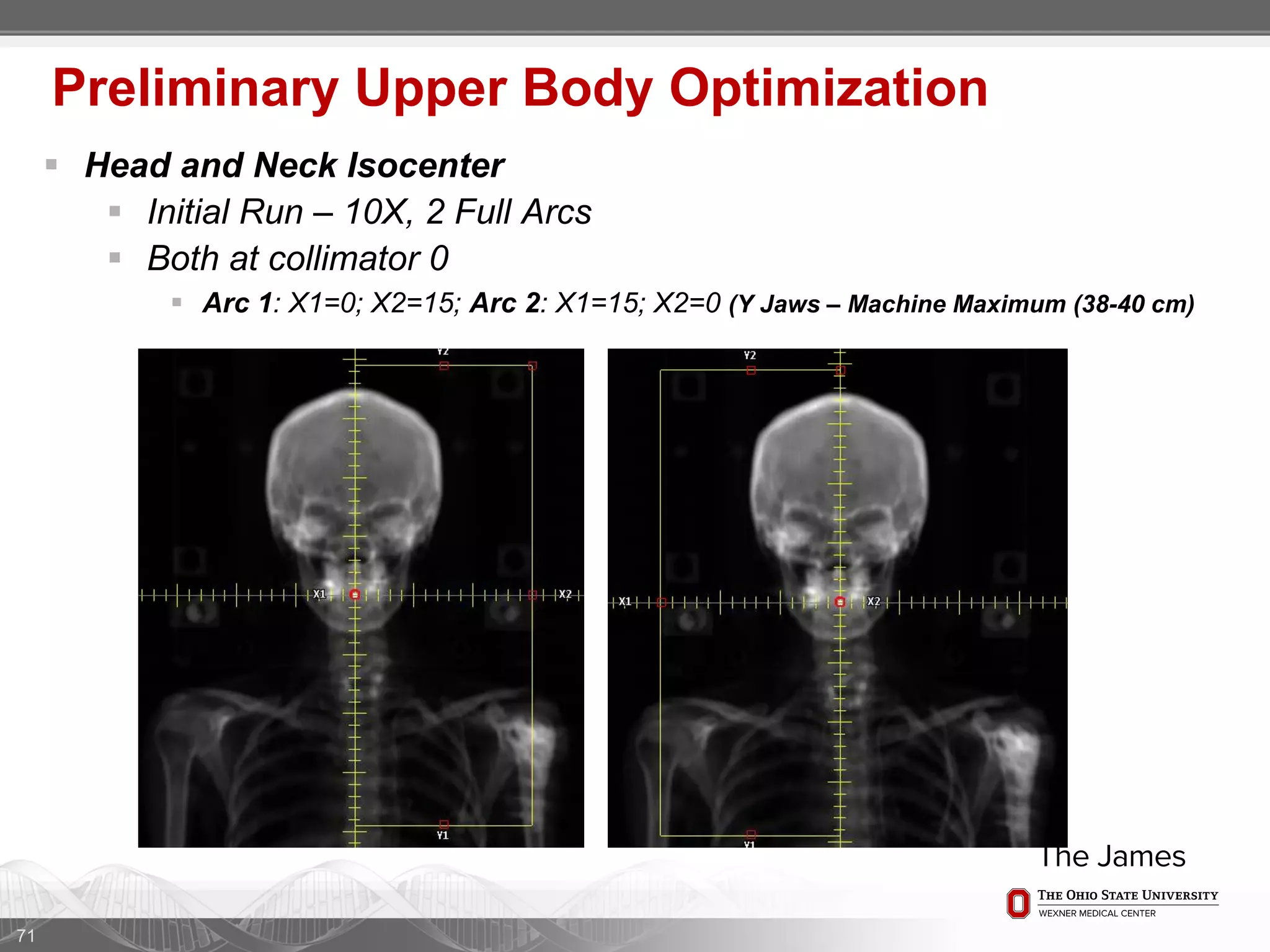  Head and Neck Isocenter
 Initial Run – 10X, 2 Full Arcs
 Both at collimator 0
 Arc 1: X1=0; X2=15; Arc 2: X1=15; X2=0 (Y Jaws – Machine Maximum (38-40 cm)
71
Preliminary Upper Body Optimization
 