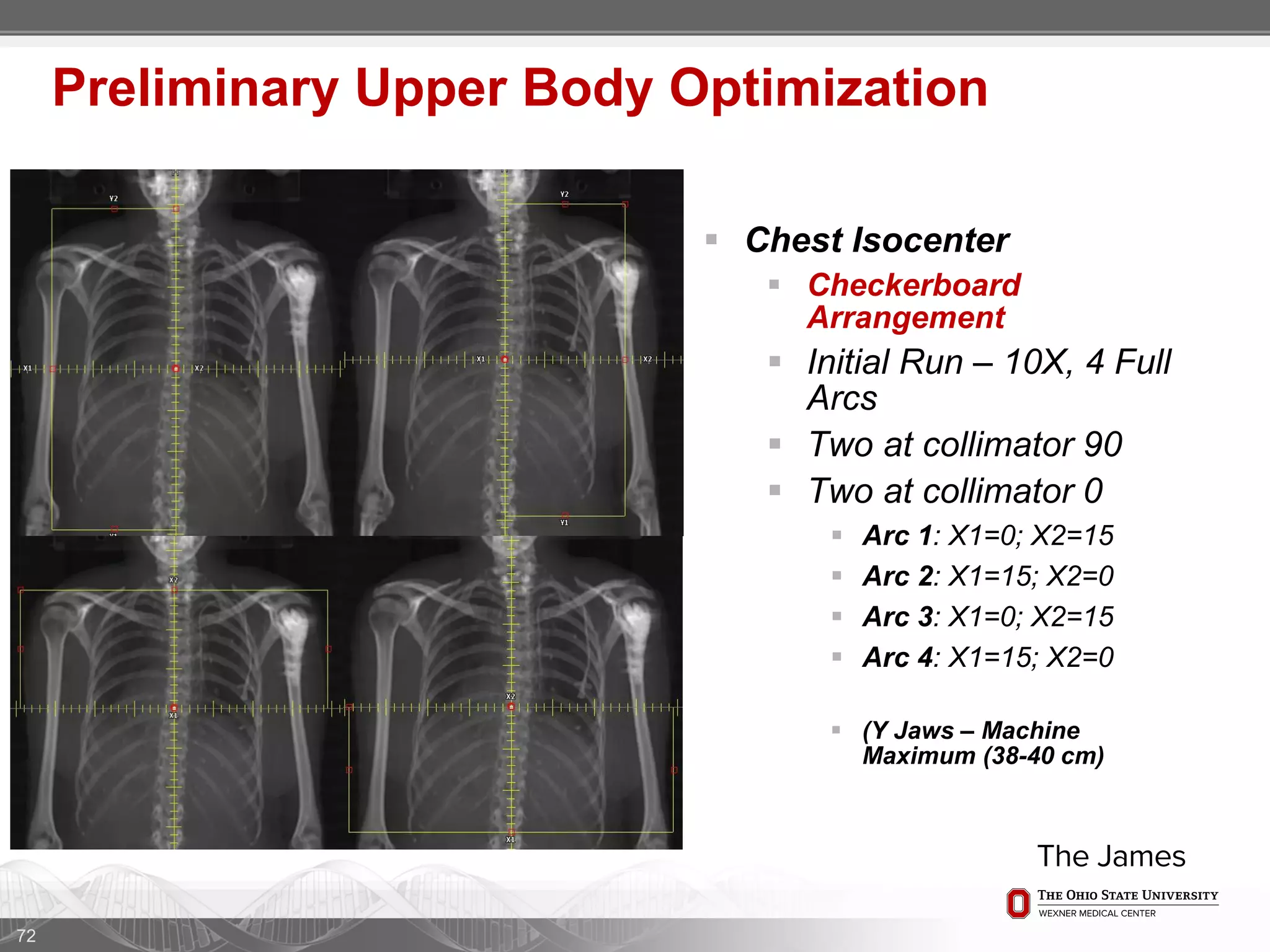  Chest Isocenter
 Checkerboard
Arrangement
 Initial Run – 10X, 4 Full
Arcs
 Two at collimator 90
 Two at collimator 0
 Arc 1: X1=0; X2=15
 Arc 2: X1=15; X2=0
 Arc 3: X1=0; X2=15
 Arc 4: X1=15; X2=0
 (Y Jaws – Machine
Maximum (38-40 cm)
72
Preliminary Upper Body Optimization
 