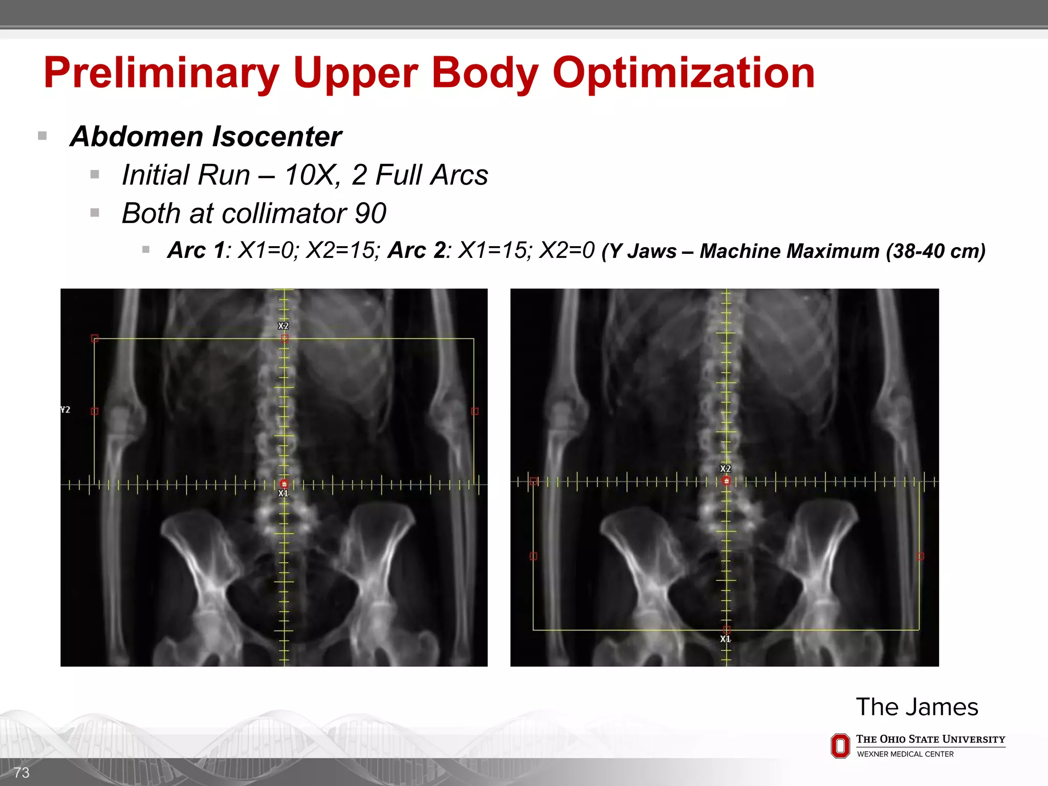  Abdomen Isocenter
 Initial Run – 10X, 2 Full Arcs
 Both at collimator 90
 Arc 1: X1=0; X2=15; Arc 2: X1=15; X2=0 (Y Jaws – Machine Maximum (38-40 cm)
73
Preliminary Upper Body Optimization
 