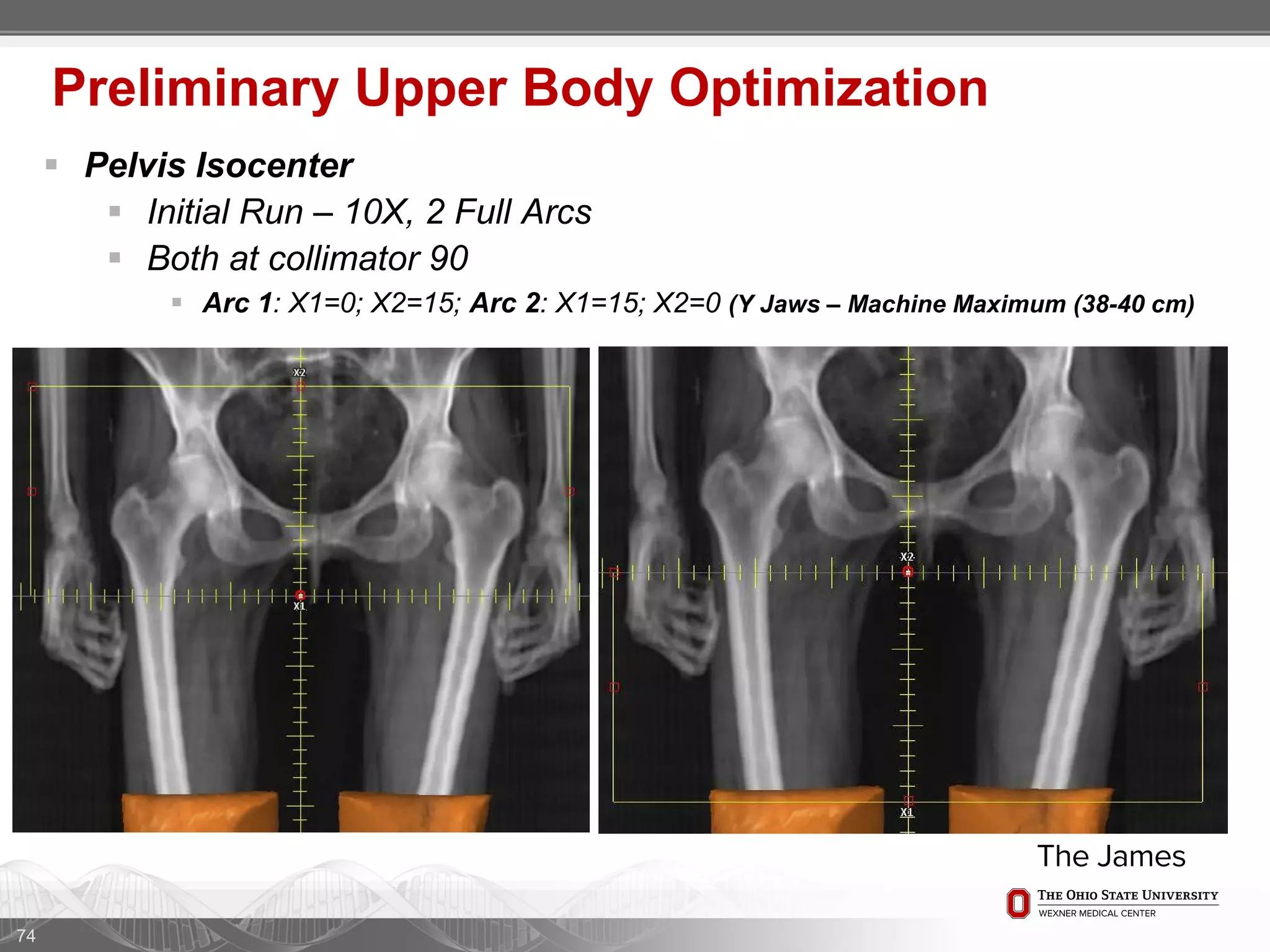  Pelvis Isocenter
 Initial Run – 10X, 2 Full Arcs
 Both at collimator 90
 Arc 1: X1=0; X2=15; Arc 2: X1=15; X2=0 (Y Jaws – Machine Maximum (38-40 cm)
74
Preliminary Upper Body Optimization
 