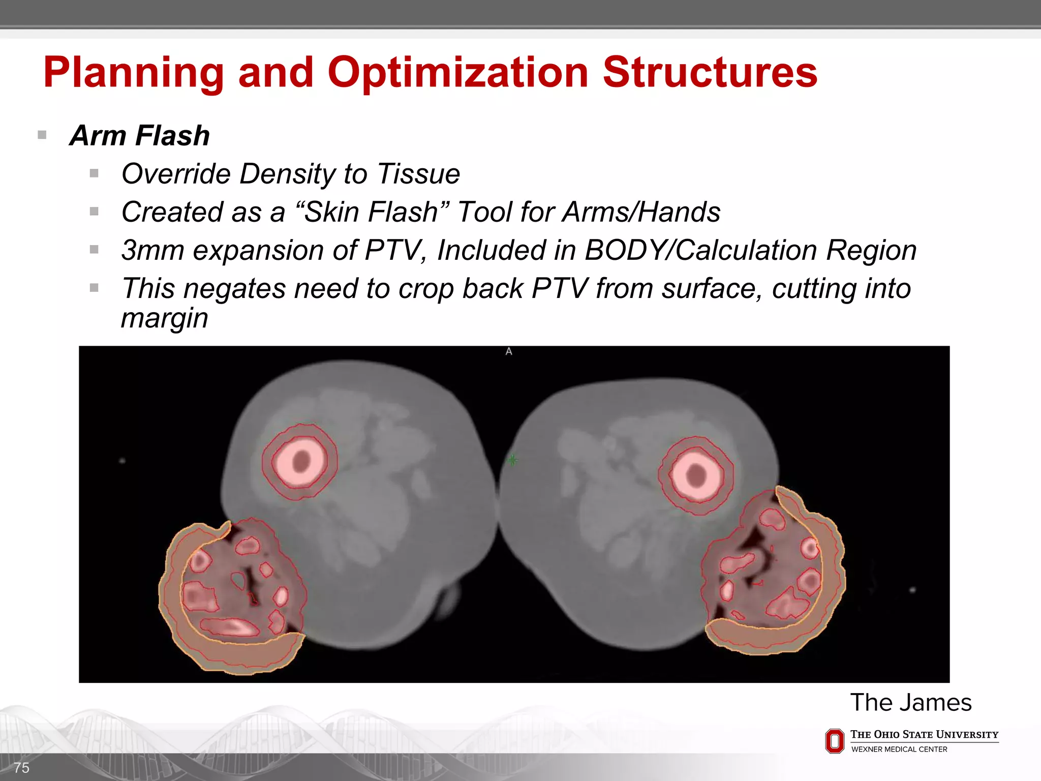 75
Planning and Optimization Structures
 Arm Flash
 Override Density to Tissue
 Created as a “Skin Flash” Tool for Arms/Hands
 3mm expansion of PTV, Included in BODY/Calculation Region
 This negates need to crop back PTV from surface, cutting into
margin
 