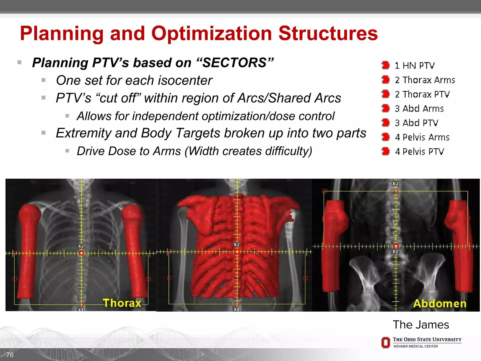 76
Planning and Optimization Structures
 Planning PTV’s based on “SECTORS”
 One set for each isocenter
 PTV’s “cut off” within region of Arcs/Shared Arcs
 Allows for independent optimization/dose control
 Extremity and Body Targets broken up into two parts
 Drive Dose to Arms (Width creates difficulty)
 