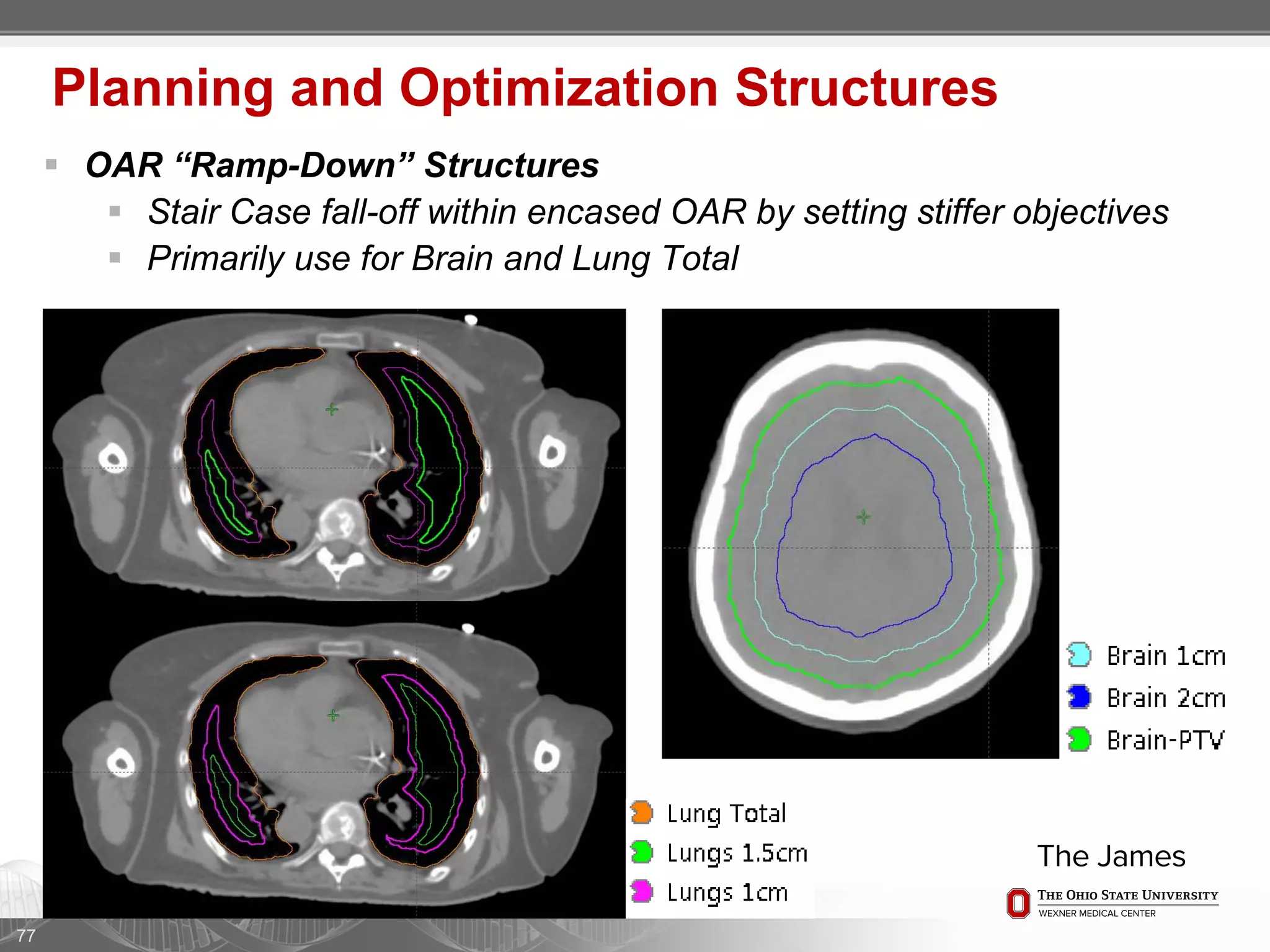 77
Planning and Optimization Structures
 OAR “Ramp-Down” Structures
 Stair Case fall-off within encased OAR by setting stiffer objectives
 Primarily use for Brain and Lung Total
 