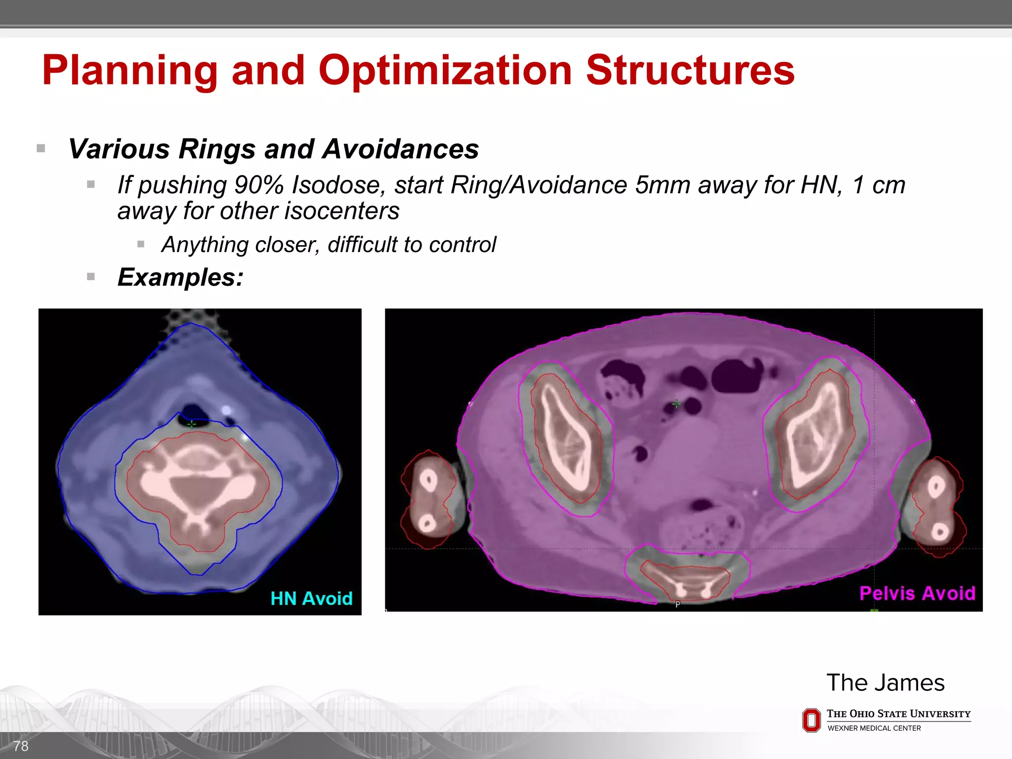 78
Planning and Optimization Structures
 Various Rings and Avoidances
 If pushing 90% Isodose, start Ring/Avoidance 5mm away for HN, 1 cm
away for other isocenters
 Anything closer, difficult to control
 Examples:
 