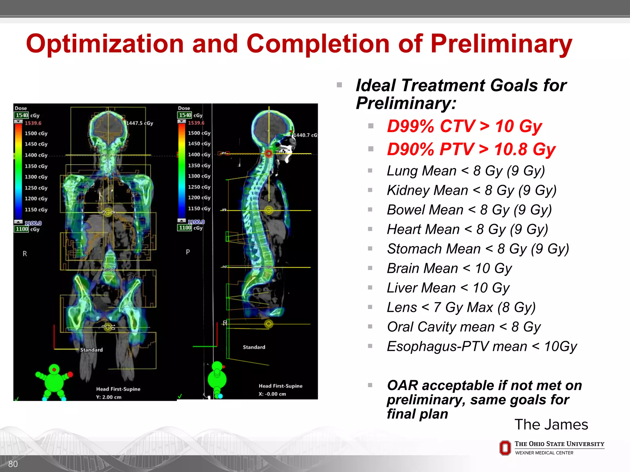 80
Optimization and Completion of Preliminary
 Ideal Treatment Goals for
Preliminary:
 D99% CTV > 10 Gy
 D90% PTV > 10.8 Gy
 Lung Mean < 8 Gy (9 Gy)
 Kidney Mean < 8 Gy (9 Gy)
 Bowel Mean < 8 Gy (9 Gy)
 Heart Mean < 8 Gy (9 Gy)
 Stomach Mean < 8 Gy (9 Gy)
 Brain Mean < 10 Gy
 Liver Mean < 10 Gy
 Lens < 7 Gy Max (8 Gy)
 Oral Cavity mean < 8 Gy
 Esophagus-PTV mean < 10Gy
 OAR acceptable if not met on
preliminary, same goals for
final plan
 