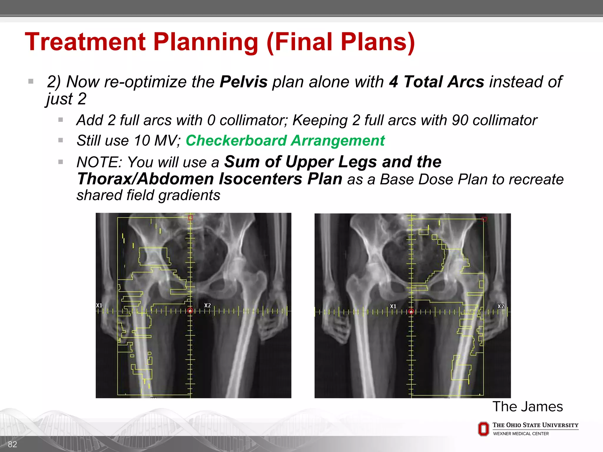  2) Now re-optimize the Pelvis plan alone with 4 Total Arcs instead of
just 2
 Add 2 full arcs with 0 collimator; Keeping 2 full arcs with 90 collimator
 Still use 10 MV; Checkerboard Arrangement
 NOTE: You will use a Sum of Upper Legs and the
Thorax/Abdomen Isocenters Plan as a Base Dose Plan to recreate
shared field gradients
82
Treatment Planning (Final Plans)
 