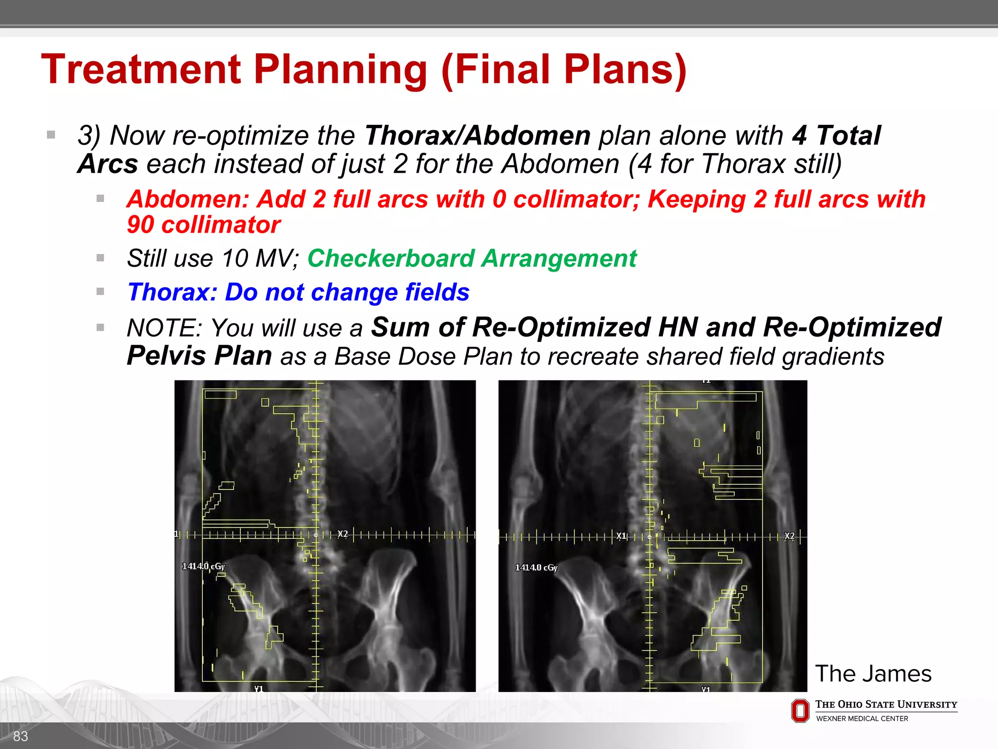  3) Now re-optimize the Thorax/Abdomen plan alone with 4 Total
Arcs each instead of just 2 for the Abdomen (4 for Thorax still)
 Abdomen: Add 2 full arcs with 0 collimator; Keeping 2 full arcs with
90 collimator
 Still use 10 MV; Checkerboard Arrangement
 Thorax: Do not change fields
 NOTE: You will use a Sum of Re-Optimized HN and Re-Optimized
Pelvis Plan as a Base Dose Plan to recreate shared field gradients
83
Treatment Planning (Final Plans)
 