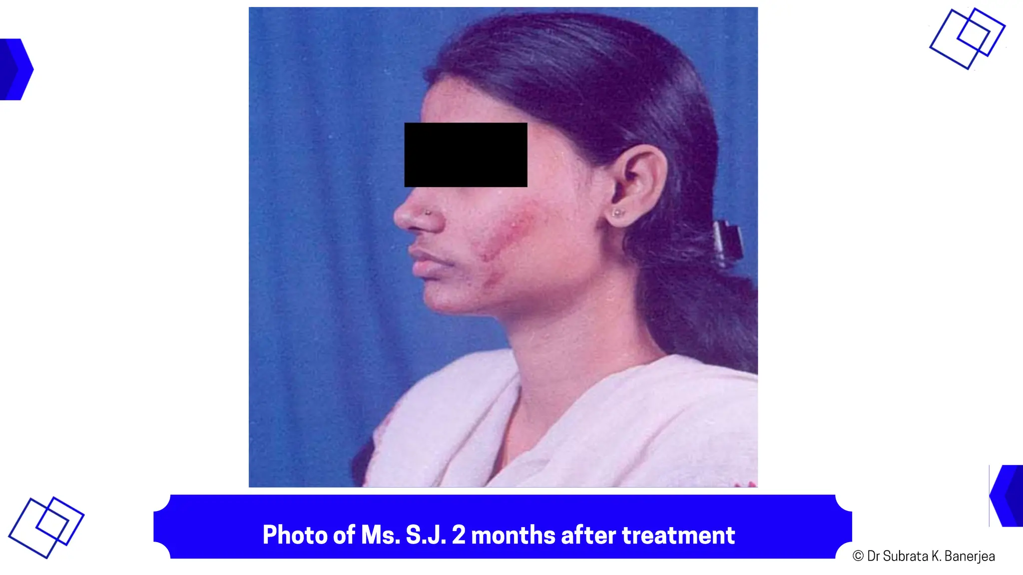 ACH - CURED CASE PPT - D006-ECZEMATOUS ULCER IN CHEEK-SJ.pptx