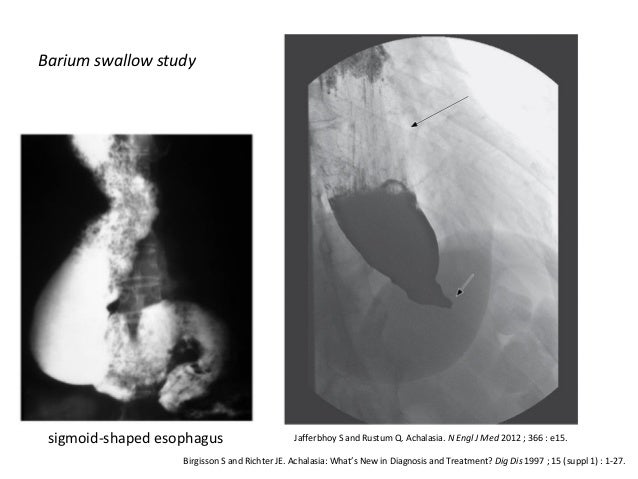 home remedies for achalasia cardia