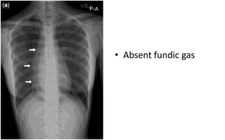 Achalasia | PPTX