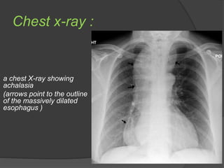 Achalasia | PPTX