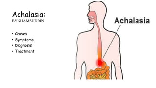 Achalasia:
BY SHAMSUDDIN
• Causes
• Symptoms
• Diagnosis
• Treatment
 