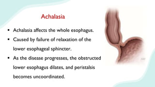 Achalasia
 Achalasia affects the whole esophagus.
 Caused by failure of relaxation of the
lower esophageal sphincter.
 As the disease progresses, the obstructed
lower esophagus dilates, and peristalsis
becomes uncoordinated.
 