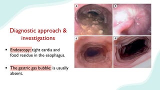 Diagnostic approach &
investigations
 Endoscopy: tight cardia and
food residue in the esophagus.
 The gastric gas bubble: is usually
absent.
 