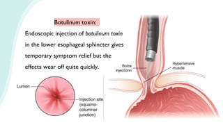 Botulinum toxin:
Endoscopic injection of botulinum toxin
in the lower esophageal sphincter gives
temporary symptom relief but the
effects wear off quite quickly.
 