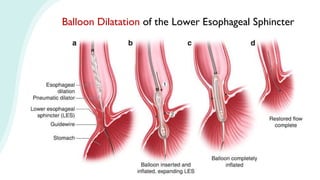 Balloon Dilatation of the Lower Esophageal Sphincter
 
