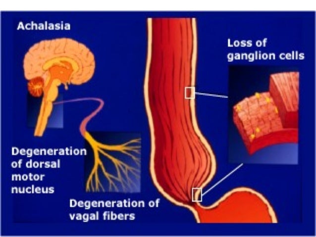 Achalasia disease of GIT