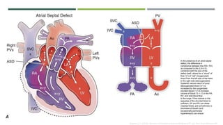 Acyanotic congenital heart disease | PPTX