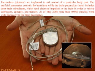 Pacemakers (pictured) are implanted to aid control of a particular body part. The artificial pacemaker controls the heartbeats while the brain pacemaker (inset) includes deep brain stimulators, which send electrical impulses to the brain in order to relieve depression, epilepsy, and tremors. As of May 2008 more than 40,000 patients word wide had received the brain pacemaker. PACEMAKER 