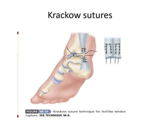 Ta Rupture Achilis tendon rupture | PPTX