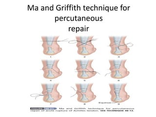 Ta Rupture Achilis tendon rupture | PPTX