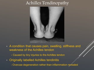Achilles Tendinopathy
• A condition that causes pain, swelling, stiffness and
weakness of the Achilles tendon
- Caused by tiny injuries to the Achilles tendon
• Originally labelled Achilles tendinitis
- Overuse degeneration rather than inflammation revealed
 