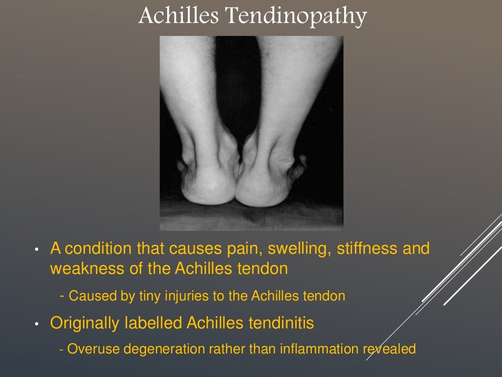 Achilles tendinopathy, overview & biomechanical causes