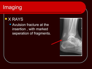 Imaging
X RAYS
Avulsion fracture at the
insertion , with marked
seperation of fragments.
 