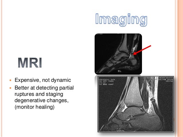 Shoes After Achilles Tendon Surgery