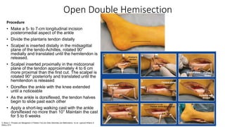 Open Double Hemisection
Procedure
• Make a 5- to 7-cm longitudinal incision
posteromedial aspect of the ankle
• Divide the plantaris tendon distally
• Scalpel is inserted distally in the midsagittal
plane of the tendo-Achilles, rotated 90°
medially and translated until the hemitendon is
released.
• Scalpel inserted proximally in the midcoronal
plane of the tendon approximately 4 to 6 cm
more proximal than the first cut. The scalpel is
rotated 90° posteriorly and translated until the
hemitendon is released
• Dorsiflex the ankle with the knee extended
until a noticeable
• As the ankle is dorsiflexed, the tendon halves
begin to slide past each other
• Apply a short-leg walking cast with the ankle
dorsiflexed no more than 10° Maintain the cast
for 5 to 6 weeks
S. Mosca V. Principles and Management of Pediatric Foot and Ankle Deformities and Malformations. 1st ed. Lippincott Williams &
Wilkins; 2014.
 