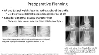 Preoperative Planning
• AP and Lateral weight-bearing radiographs of the ankle
• Used to evaluate lateral tibiocalcanel angle (normal 25-60)
• Consider abnormal osseus characteristics
• Flattened talar dome, anterior distal tibial osteophytes
Talar sphericity patterns: (A) normal, enabling good mobility of
the joint, (B) slightly flattened, (C) greatly altered or flat.
Ankle Joint–Lateral view: (A) grade 0 normal, (B)
grade 1 anterior tibial osteophyte, (C) grade 3
anterior tibial osteophyte, (D) grade 3 anterior
tibial osteophyte
Tabaie, S., & Videckis, A. (2021). Achilles Lengthening. JPOSNA®, 3(3). https://doi.org/10.55275/JPOSNA-2021-310
 