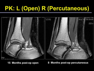 Ta Rupture Achilles tendon repair | PPT
