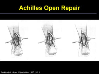 Achilles Open Repair Beskin et al.  Amer J Sports Med  1987 15:1 1 