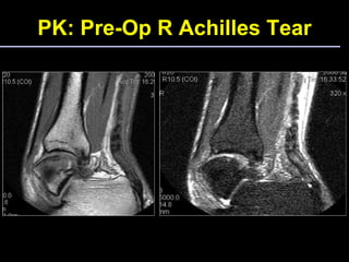 PK: Pre-Op R Achilles Tear 