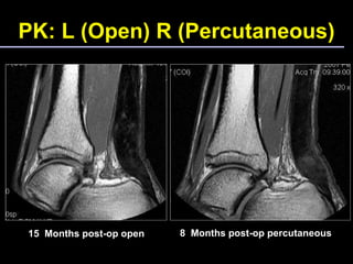 PK: L (Open) R (Percutaneous) 8  Months post-op percutaneous 15  Months post-op open 