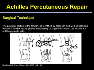 Achilles Percutaneous Repair Surgical Technique The proximal portion of the tendon, as identified by palpation and MRI, is...