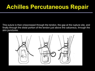 Achilles Percutaneous Repair This suture is then crisscrossed through the tendon, the gap at the rupture site, and finally...