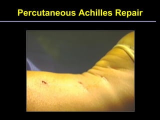 Percutaneous Achilles Repair 