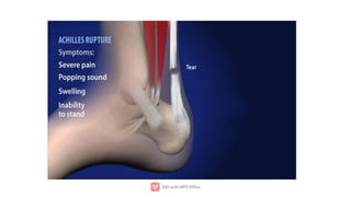 Ta Rupture ACHILLES TENDON RUPTURE.pdf