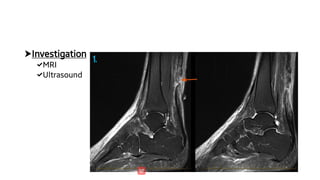 Ta Rupture ACHILLES TENDON RUPTURE.pdf