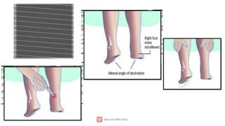 Ta Rupture ACHILLES TENDON RUPTURE.pdf