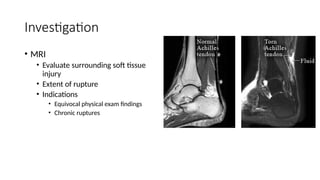 Ta Rupture Achilles tendon rupture treatment management | PPTX