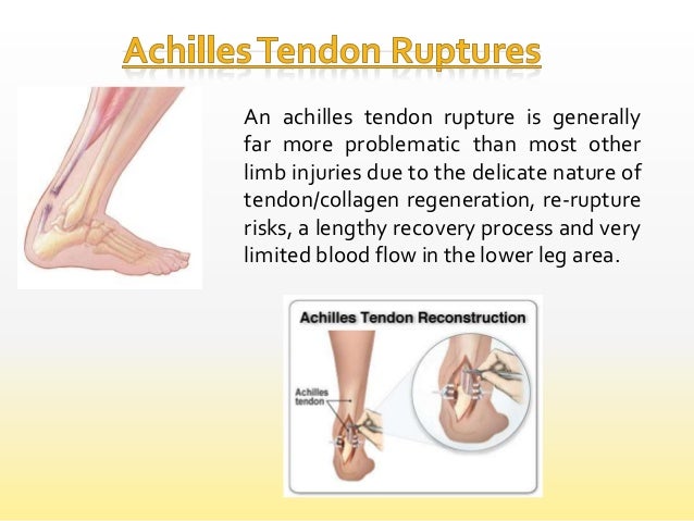 Achilles rupture