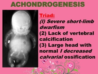 ACHONDROGENESIS
Triad:
(l) Severe short-limb
dwarfism
(2) Lack of vertebral
calcification
(3) Large head with
normal I decreased
calvarial ossification
 