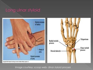 Image courtesy: scoop web- Ulnar styloid process

 