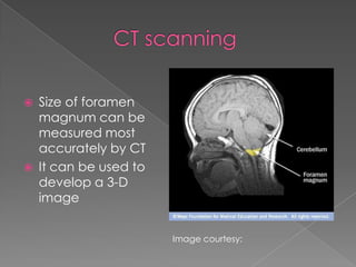 



Size of foramen
magnum can be
measured most
accurately by CT
It can be used to
develop a 3-D
image
Image courtesy:

 
