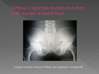 Image courtesy: Wayne H.Riser, Hip dysplasia- Chapter 83

 