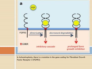 In Achondroplasia, there is a mutation in the gene coding for Fibroblast Growth
Factor Receptor 3 (FGFR3)
 