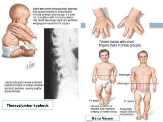 Thoracolumbar kyphosis
Genu Varum
 